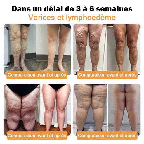 Bracelet de détox pour lipolyse ultrasonique et équilibre infrarouge lointain avec glycémie 🤩